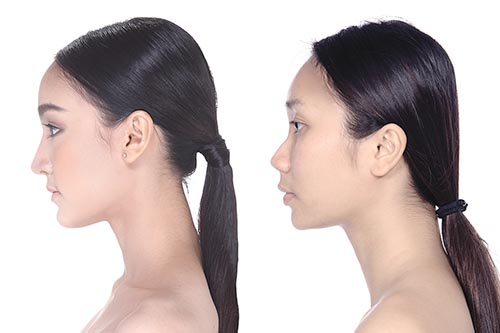 鼻の形を整える様々な施術