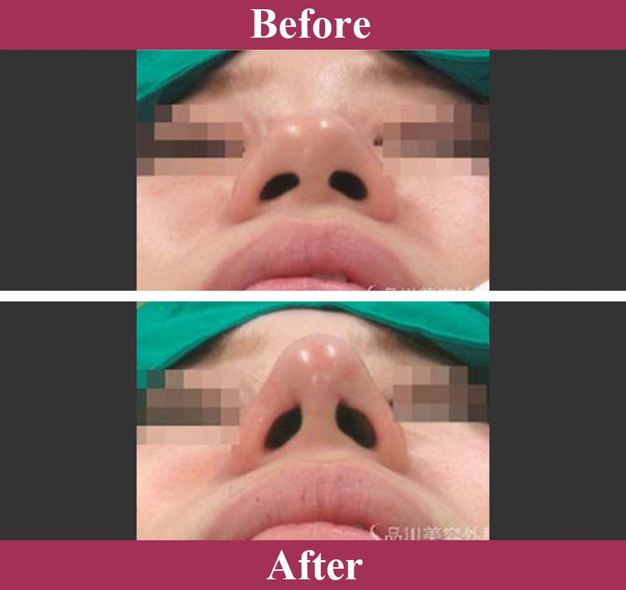 1day鼻先縮小 症例写真【画像】