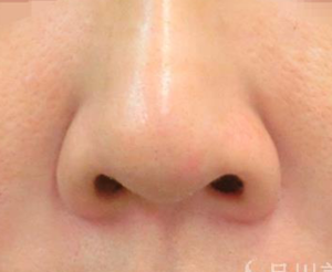 団子鼻の2つのタイプ