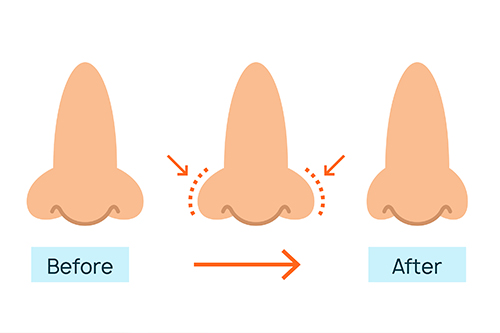美容外科での小鼻縮小術