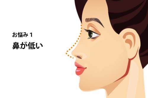 よくあるお悩み1：鼻が低い