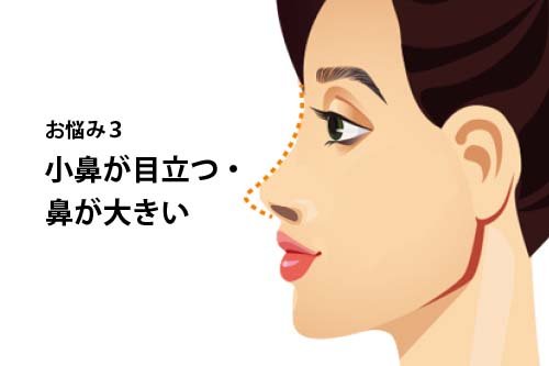 よくあるお悩み3：小鼻が目立つ・鼻が大きい
