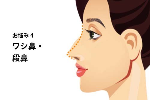 よくあるお悩み4：ワシ鼻・段鼻