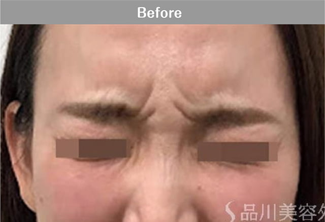 アラガン社ボツリヌス注射 症例写真 Before