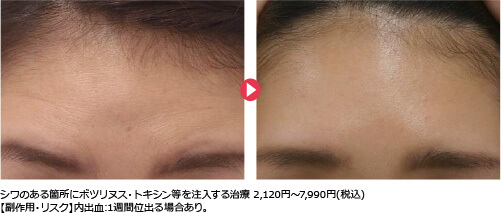 シワのある箇所にボツリヌス・トキシン等を注入する治療 2,120円～7,990円(税込)  【副作用・リスク】内出血:1週間位出る場合あり｡ 