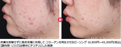 皮膚を剥離せずに真皮深層に作用して､コラーゲンを再生させるピーリング 10,800円～43,200円(税込)【副作用・リスク】治療中にチリチリとした刺激