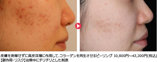 皮膚を剥離せずに真皮深層に作用して､コラーゲンを再生させるピーリング 10,800円～43,200円(税込)【副作用・リスク】治療中にチリチリとした刺激