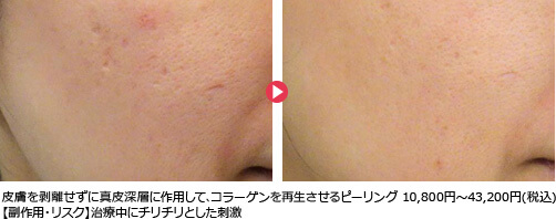 皮膚を剥離せずに真皮深層に作用して､コラーゲンを再生させるピーリング 10,800円～43,200円(税込)【副作用・リスク】治療中にチリチリとした刺激