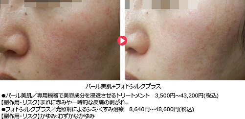 ●パール美肌／専用機器で美容成分を浸透させるトリートメント 2,140円～43,200円(税込)
              【副作用・リスク】まれに赤みや一時的な皮膚の剥がれ｡
              ●フォトシルクプラス／光照射によるシミ･くすみ治療 8,640円～48,600円(税込)
              【副作用・リスク】かゆみ:わずかなかゆみ