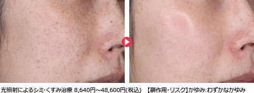 光照射によるシミ･くすみ治療 8,640円～48,600円(税込)【副作用・リスク】かゆみ:わずかなかゆみ