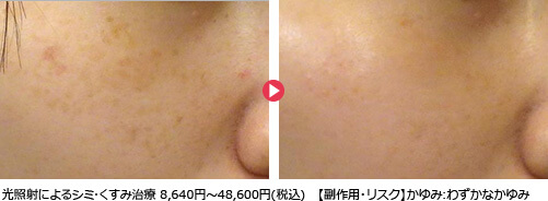 光照射によるシミ･くすみ治療 8,640円～48,600円(税込)【副作用・リスク】かゆみ:わずかなかゆみ