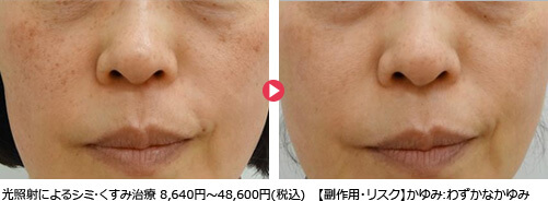 光照射によるシミ･くすみ治療 8,640円～48,600円(税込)【副作用・リスク】かゆみ:わずかなかゆみ