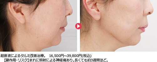 超音波によるタルミ改善治療。16,500円～39,800円(税込) 【副作用・リスク】まれに照射による神経痛あり。長くても約3週間ほど。
