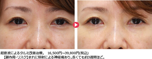 超音波によるタルミ改善治療。16,500円～39,800円(税込) 【副作用・リスク】まれに照射による神経痛あり。長くても約3週間ほど。