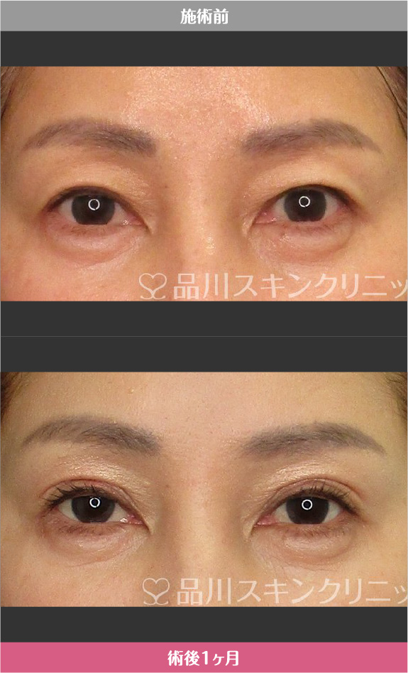 まぶたリフト​ 症例写真【画像】