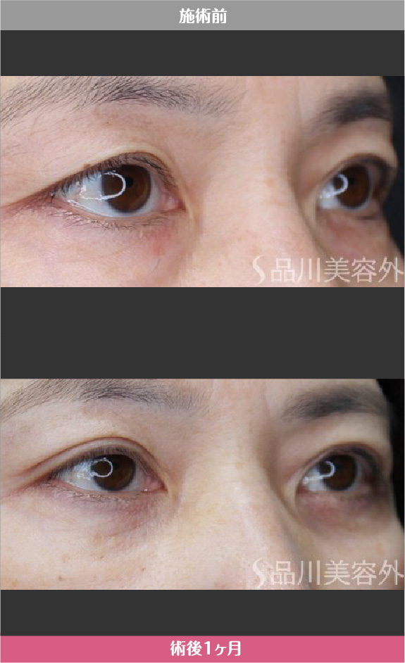 まぶたリフト​ 症例写真【画像】