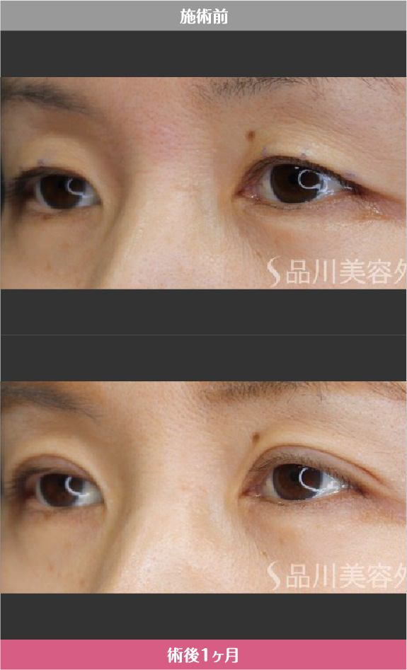 まぶたリフト​ 症例写真【画像】