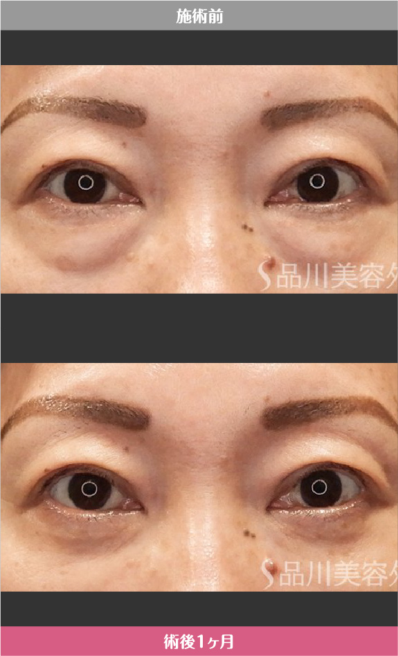 切らないクマ取り​ 症例写真【画像】