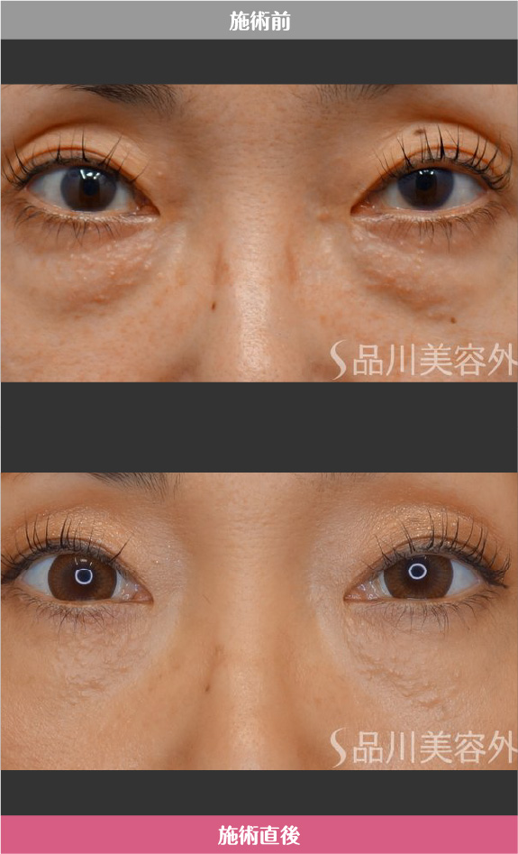 切らないクマ取り​ 症例写真【画像】