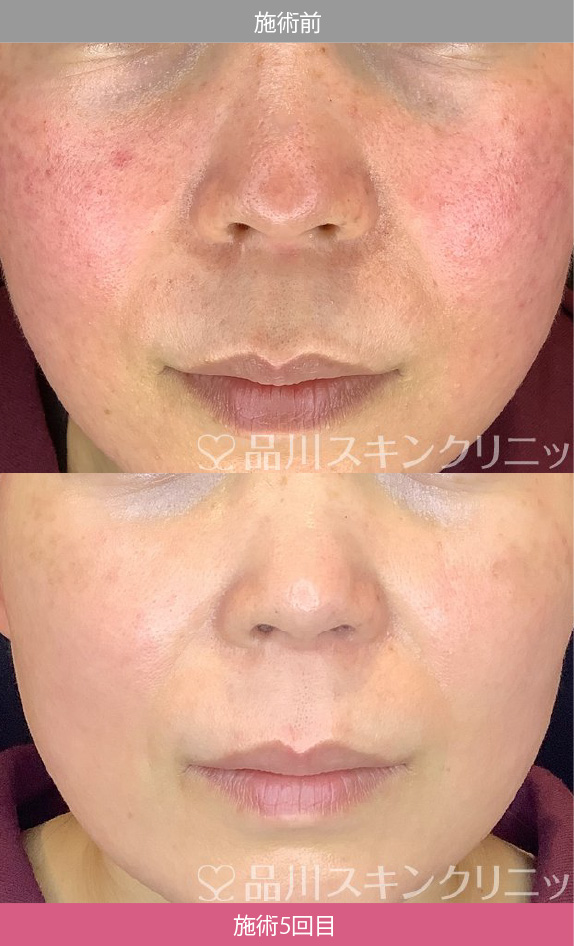 パール美肌 症例写真【画像】