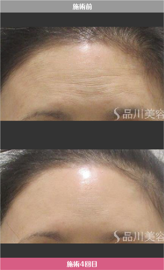 美肌注射 症例写真【画像】