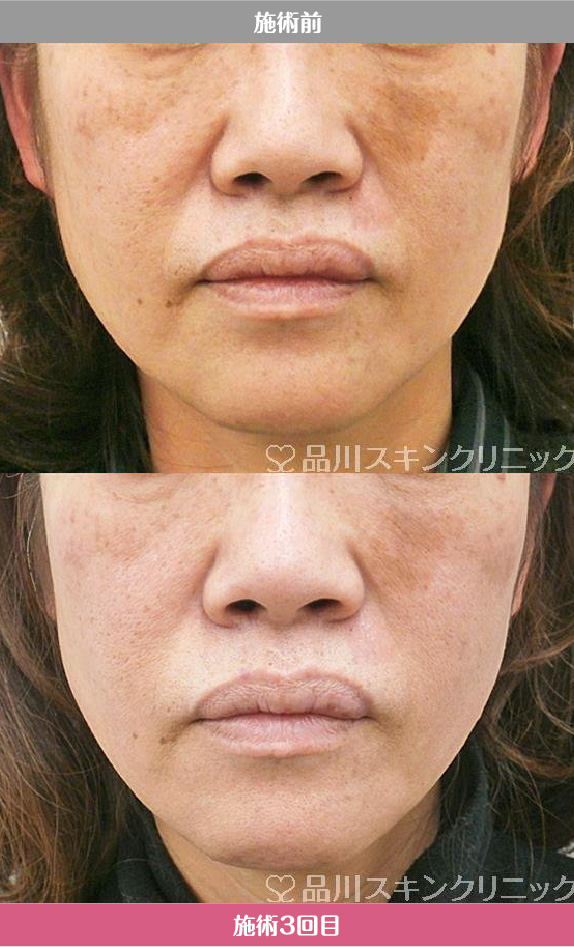 レーザートーニング 症例写真【画像】