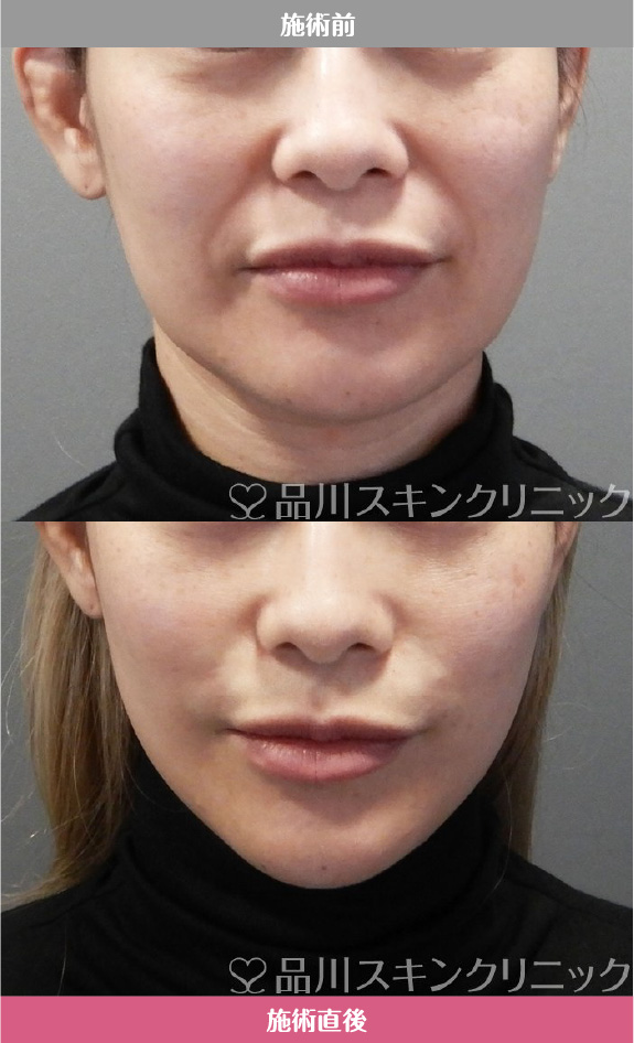 美肌糸リフト​ 症例写真【画像】