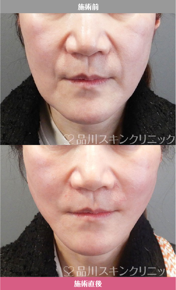 美肌糸リフト​ 症例写真【画像】