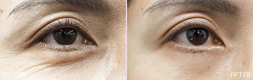 美肌注射の症例写真