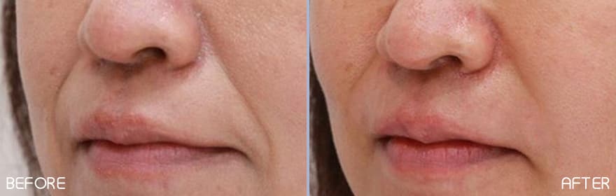 美肌注射×ヒアルロン酸注射 症例写真