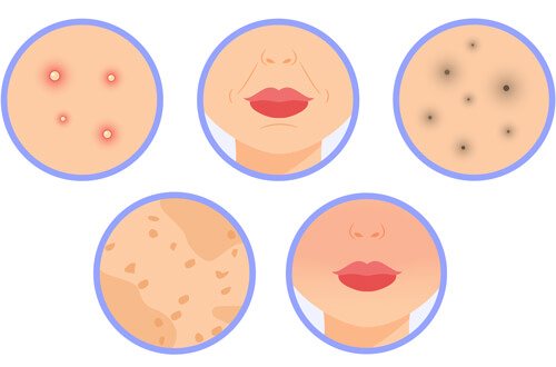 症状別！毛穴の開き以外に期待できる効果