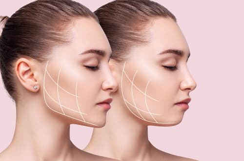 糸リフトで期待できる効果とは？お顔のたるみについても解説