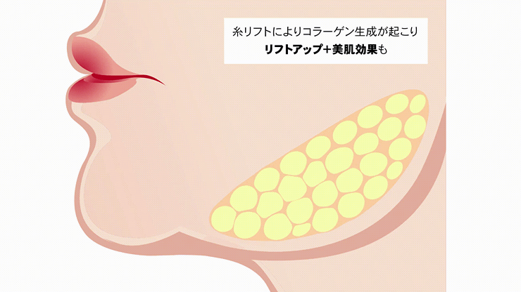 糸リフト仕組み動画