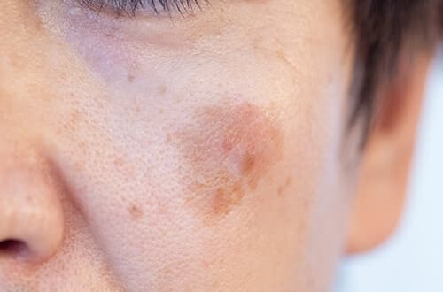 シミ取り後に現れる5つのダウンタイム症状