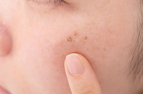 シミ取りレーザーが効果的なシミの種類