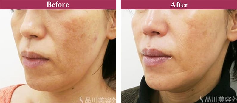 レーザートーニング 症例写真