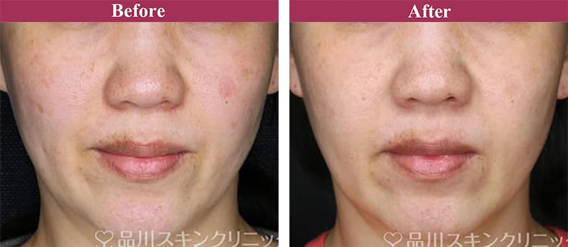 ピコレーザー 症例写真