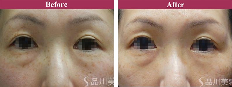 ピコレーザー 症例写真