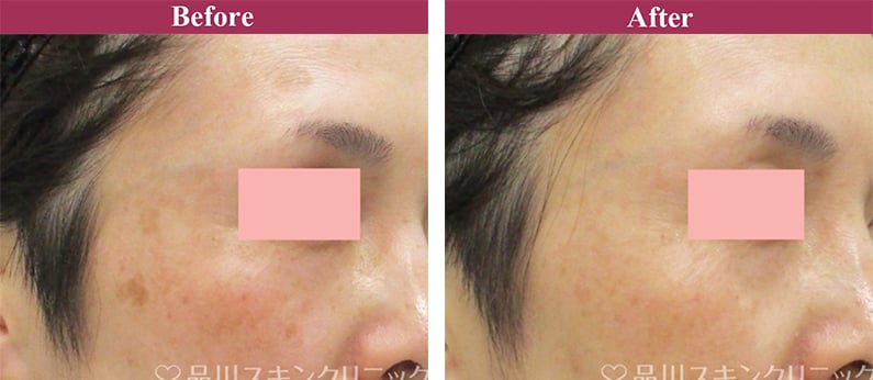 Qスイッチヤグレーザー 症例写真