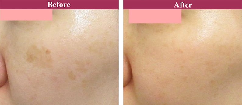 Qスイッチヤグレーザー 症例写真