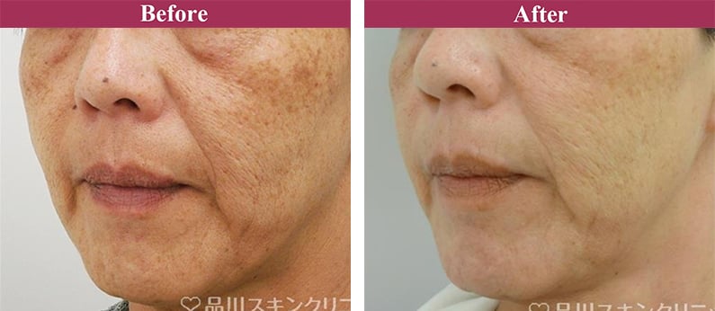 シミ・肝斑トーニング 症例写真