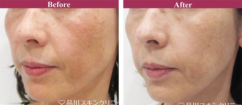 シミ・肝斑トーニング 症例写真