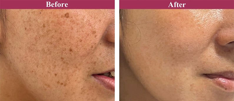 フォトシルクプラス 症例写真