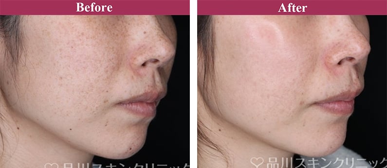 フォトシルクプラス 症例写真