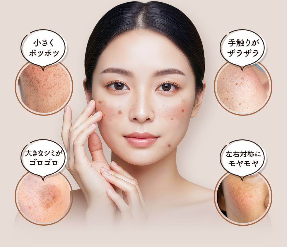 診断チャートであなたに最適なシミ取りレーザー治療をチェック！