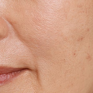 UV-Aが肌の真皮でコラーゲンを破壊