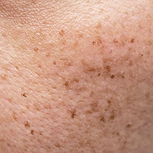 UV-Bが肌の表面でメラノサイトを刺激