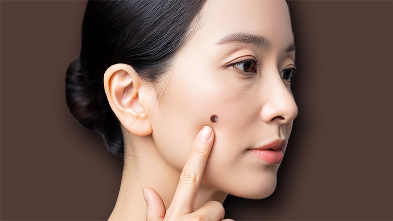 いぼ・ほくろ取りレーザー