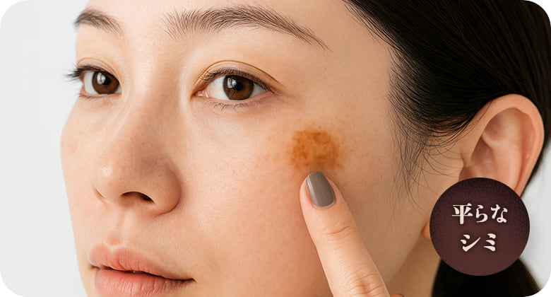 老人性色素斑（日光黒子）