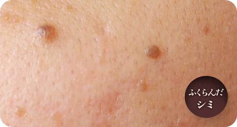 脂漏性角化症（老人性イボ）
